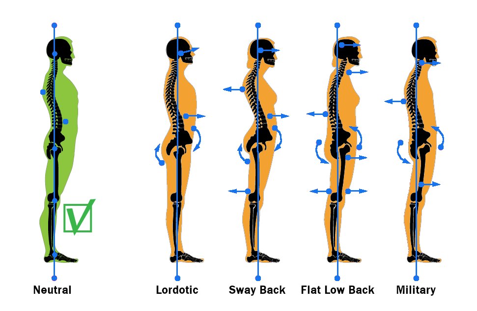 Types of Poor Posture