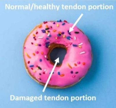 A donut: the ring is the healthy tendon portion, the hole is the damaged portion